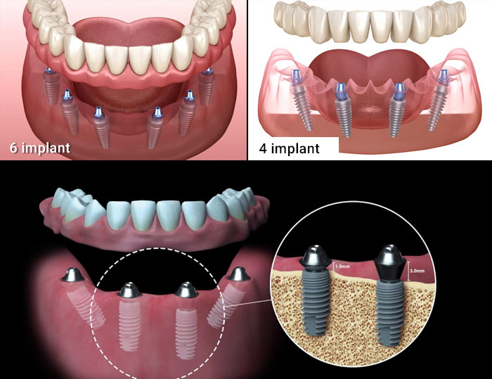 cấy ghép implant toàn hàm