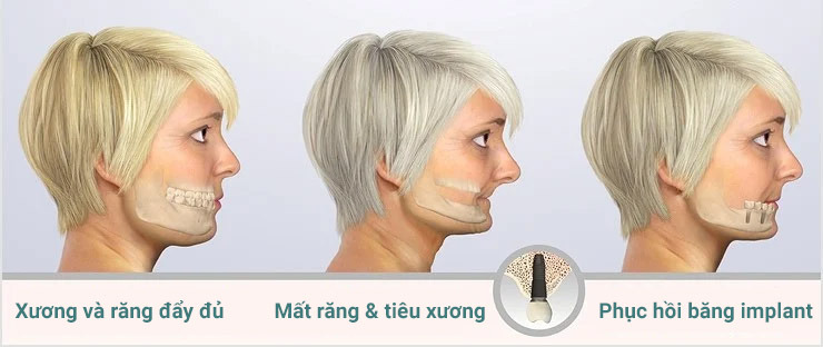 cấy ghép implant toàn hàm