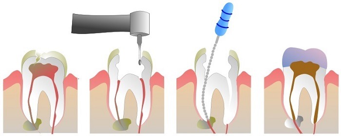 Nha Khoa Bảo Nha chữa tủy răng uy tín an toàn