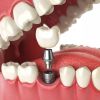 Tại sao có trường hợp sau cấy ghép Implant bị đào thải ?