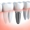 Mất một răng có nên cấy ghép Implant không ?