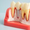 Implant tức thì là gì? Trường hợp nào có thể cấy ghép Implant tức thì ?