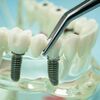 Trồng răng implant có bền không ? Tuổi thọ răng Implant giữ được bao lâu ?