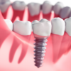 Các yếu tố rủi ro cần biết khi cấy ghép Implant kém chất lượng. Tìm hiểu kỹ trước khi quá muộn!