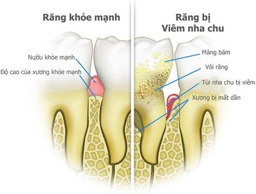 Nha chu có phải là bệnh không? Nhận biết và điều trị bệnh nha chu