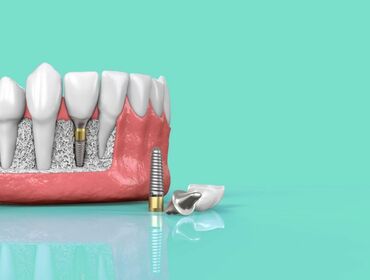 Tất tần tật những điều kiện quan trọng cần biết trước khi cấy ghép Implant toàn hàm