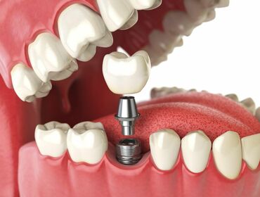 Tại sao có trường hợp sau cấy ghép Implant bị đào thải ?