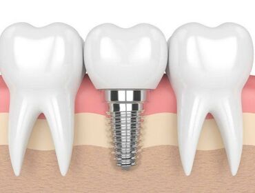 Trường hợp của tôi có thể cấy ghép Implant được hay không ?