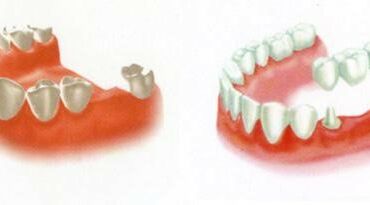 Trồng răng Implant khác trồng răng sứ ở điểm nào ?