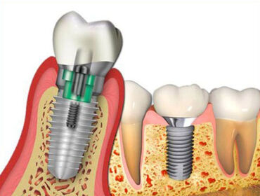 Khi nào cần ghép xương để cấy implant nha khoa