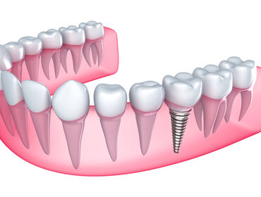 Cấy ghép Implant có an toàn không?