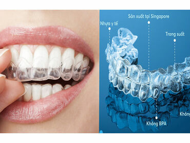 Chỉnh nha niềng răng trong suốt invisalign có hiệu quả không?