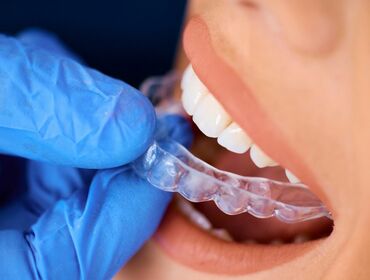 Cơ chế hoạt động của khay niềng răng Invisalign trong suốt