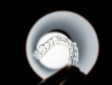 Quy trình chỉnh nha niềng răng Invisalign chuẩn y khoa tại Nha Khoa Bảo Nha