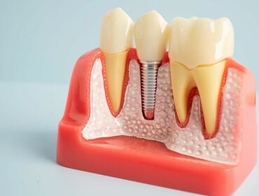 Implant tức thì là gì? Trường hợp nào có thể cấy ghép Implant tức thì?