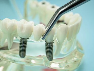 Trồng răng implant có bền không? Tuổi thọ răng Implant giữ được bao lâu?