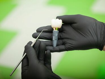 Các yếu tố quyết định thành công của một ca tiểu phẩu cấy ghép Implant