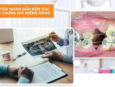 Những biến chứng có thể xảy ra khi niềng răng nếu bạn chọn phải cơ sơ nha khoa thiếu uy tín