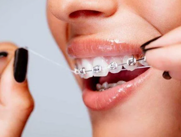 Hướng dẫn chi tiết cách vệ sinh răng miệng khi niềng răng mắc cài