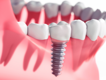 Các yếu tố rủi ro cần biết khi cấy ghép Implant kém chất lượng. Tìm hiểu kỹ trước khi quá muộn!