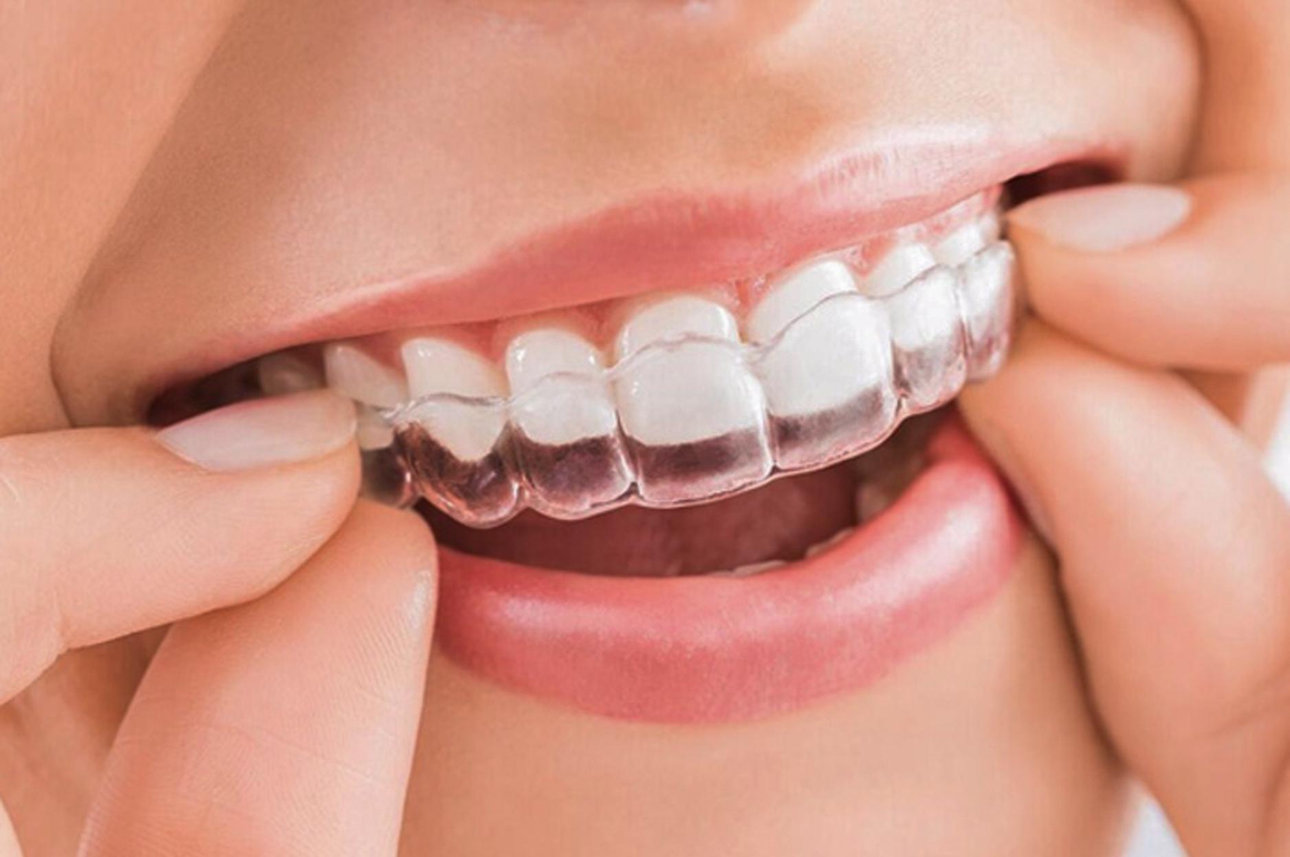 niềng răng Invisalign trong suốt