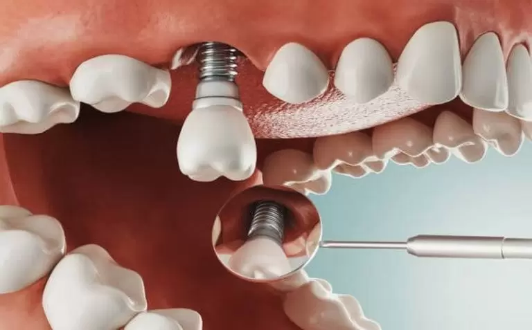 cấy ghép răng Implant giá rẻ