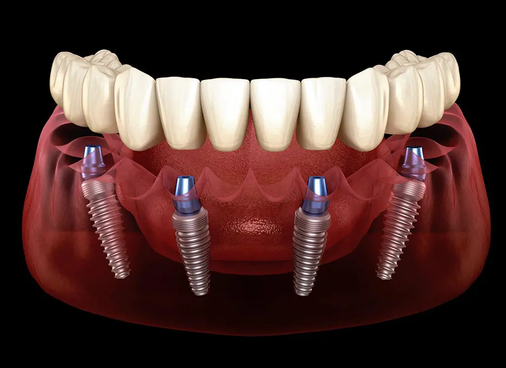 cấy ghép implant toàn hàm