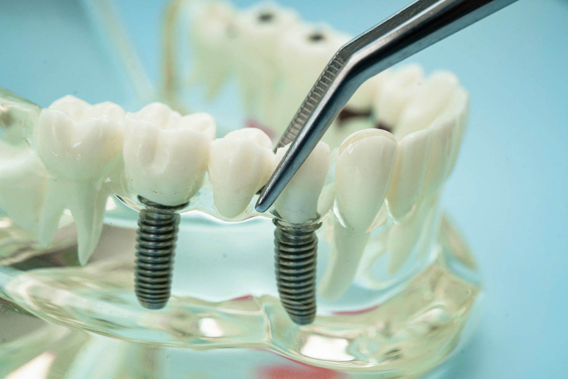 Implant bị đào thải