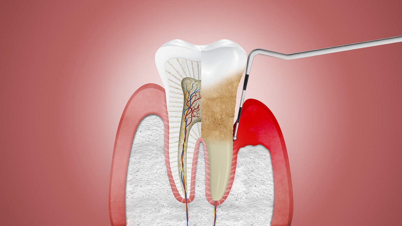 Nha Khoa Bảo Nha điều trị túi nha chu