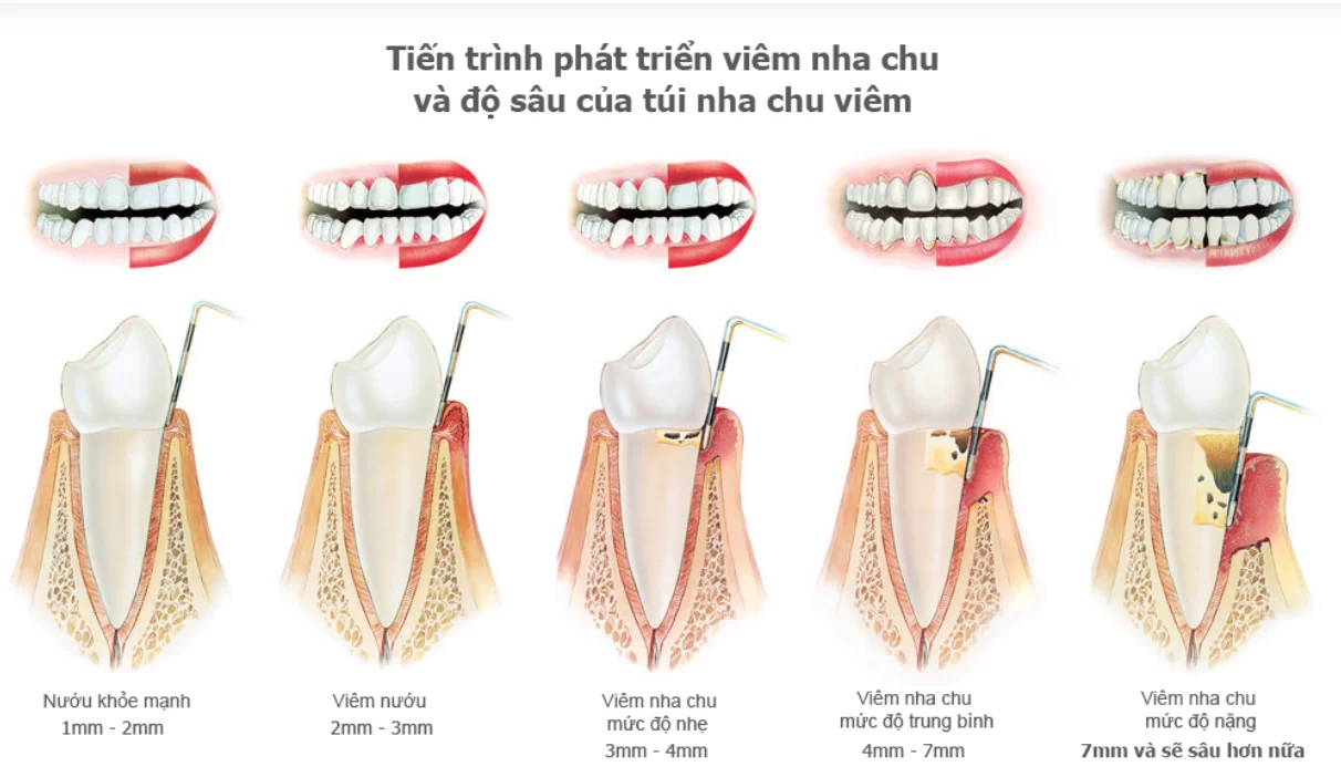 Nha Khoa Bảo Nha điều trị túi nha chu