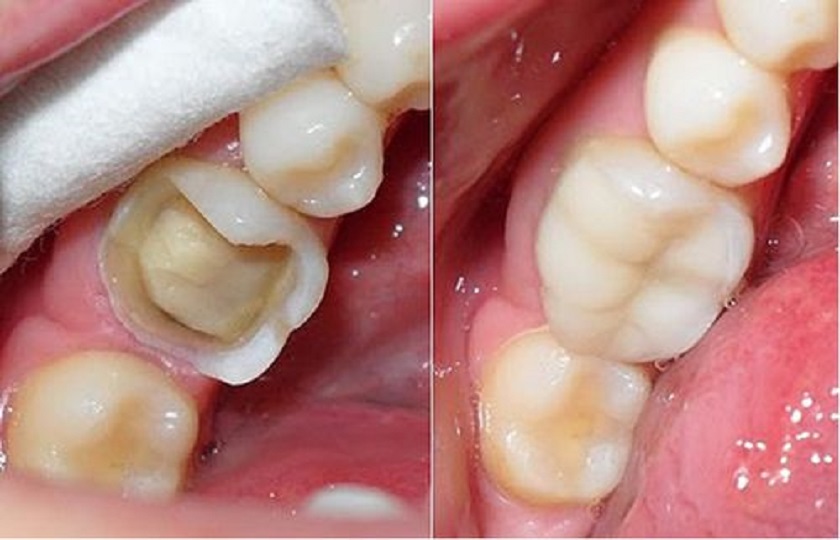 Trám răng thẩm mỹ bằng Composite