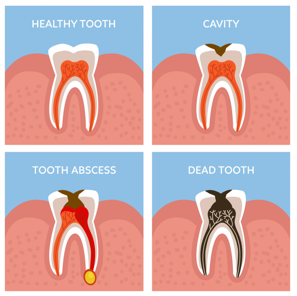 Nha Khoa Bảo Nha điều trị tủy răng