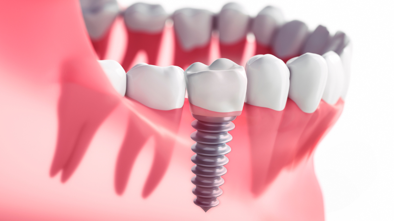 cấy ghép răng Implant giá rẻ