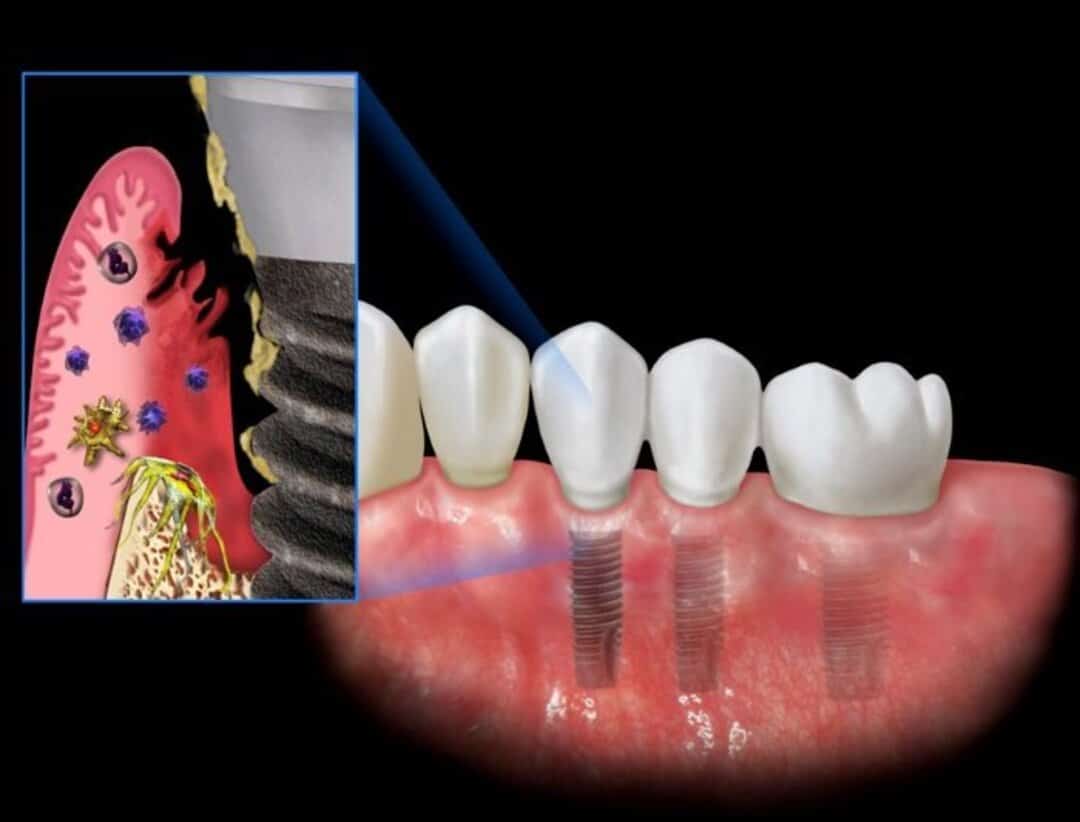 cấy ghép răng Implant giá rẻ