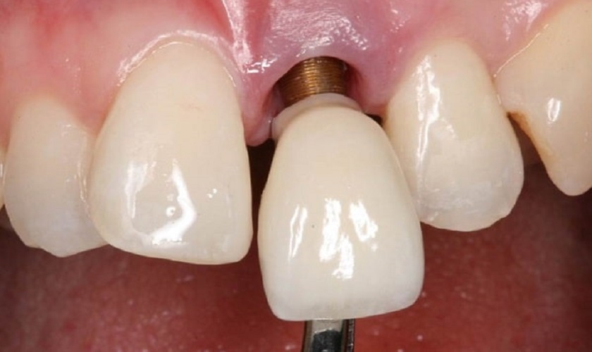 cấy ghép răng Implant giá rẻ