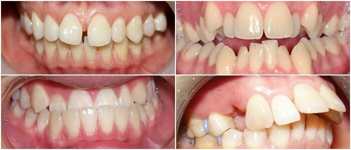 nha khoa niềng răng trong suốt Invisalign uy tín