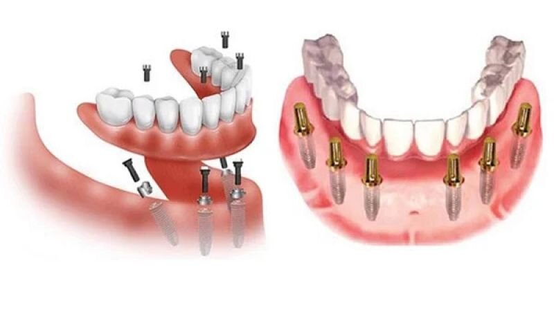 cấy ghép implant toàn hàm all on X