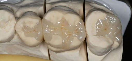 Khi nào cần trám răng Inlay-Onlay