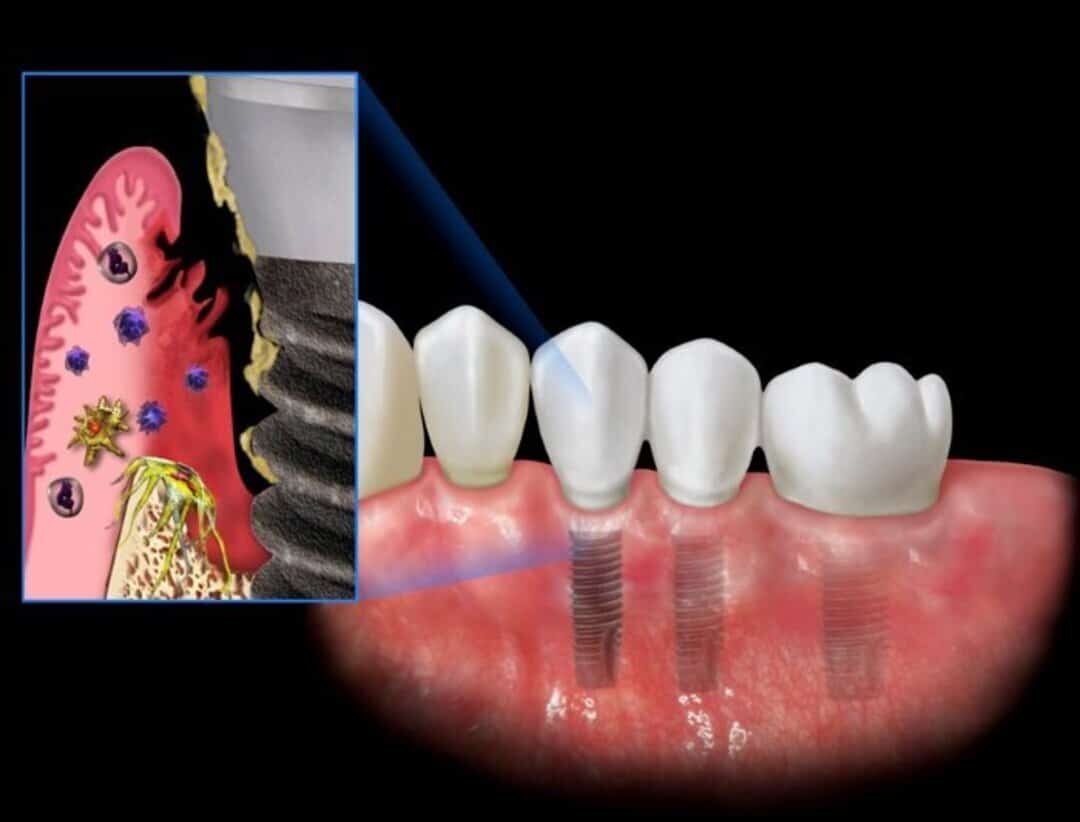 cấy ghép răng Implant giá rẻ